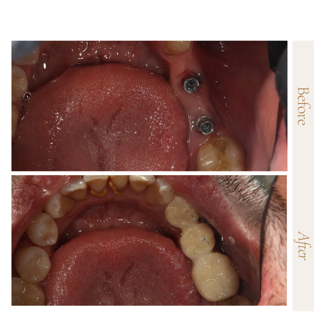 زراعة الأسنان